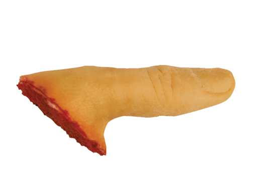 TIGA-D Abgetrennter Daumen, rechts