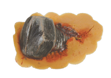 TIGA-D Wound with Screw PU Foam